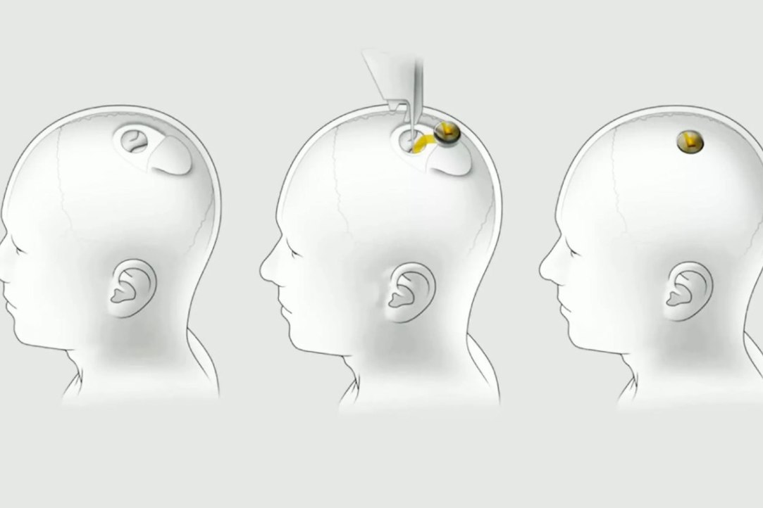 Иллюстрация к новости: Эра всеобщего чипирования: нейроинтерфейсы для человека — фантастика или уже реальность?